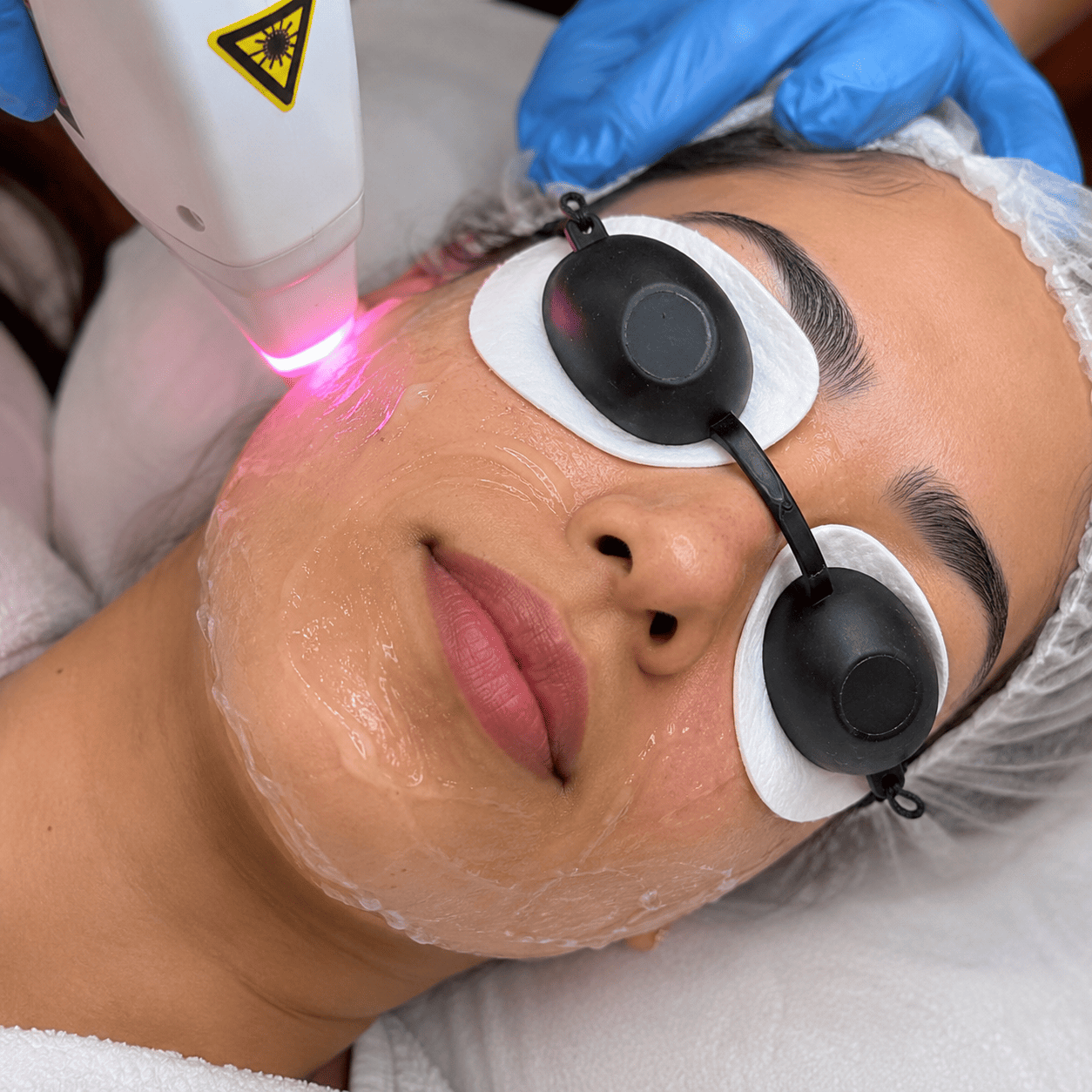 Permanent Hair Removal